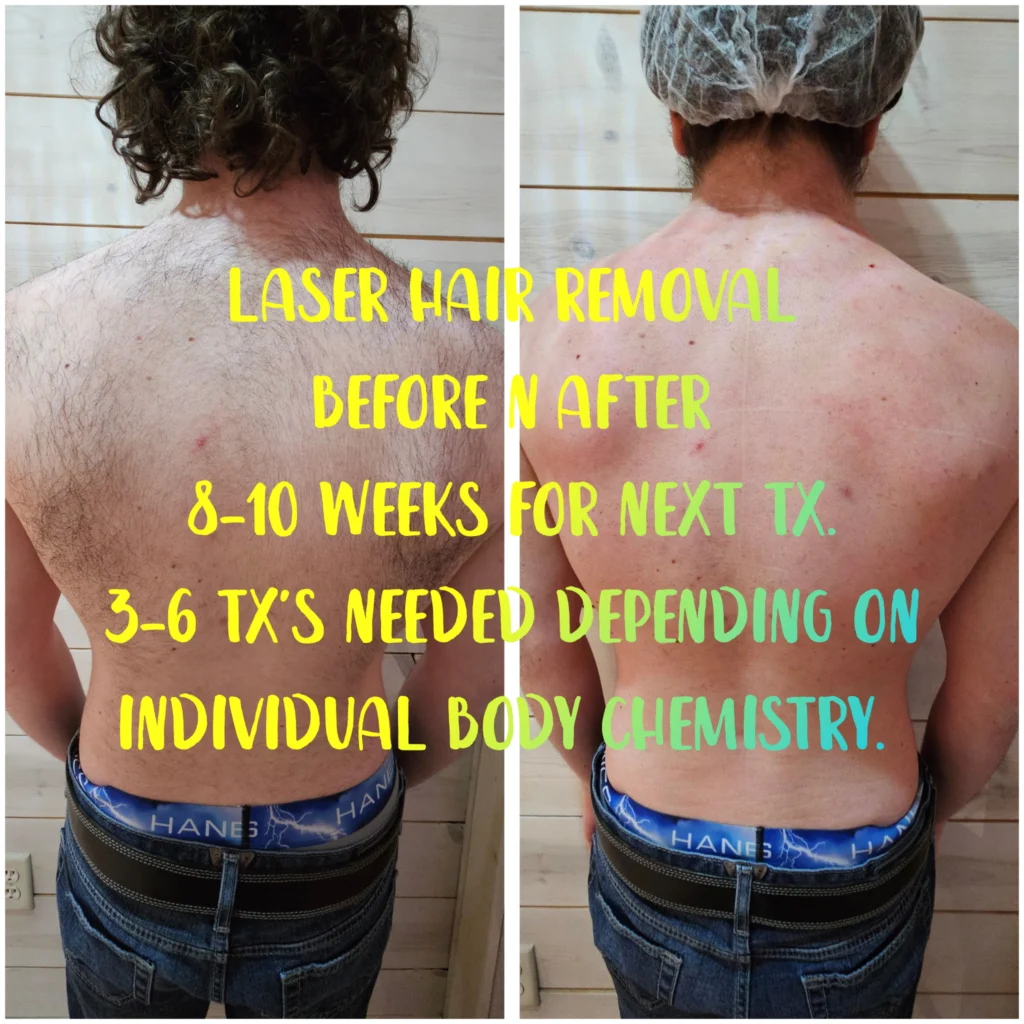 laser hair removal before after