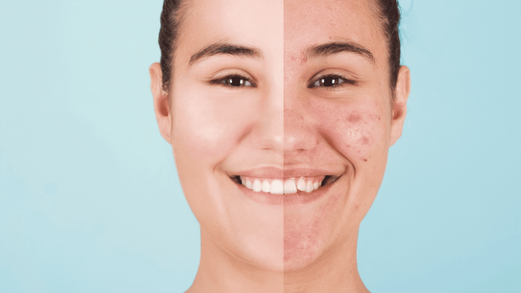 How to Get Rid of Acne Scars