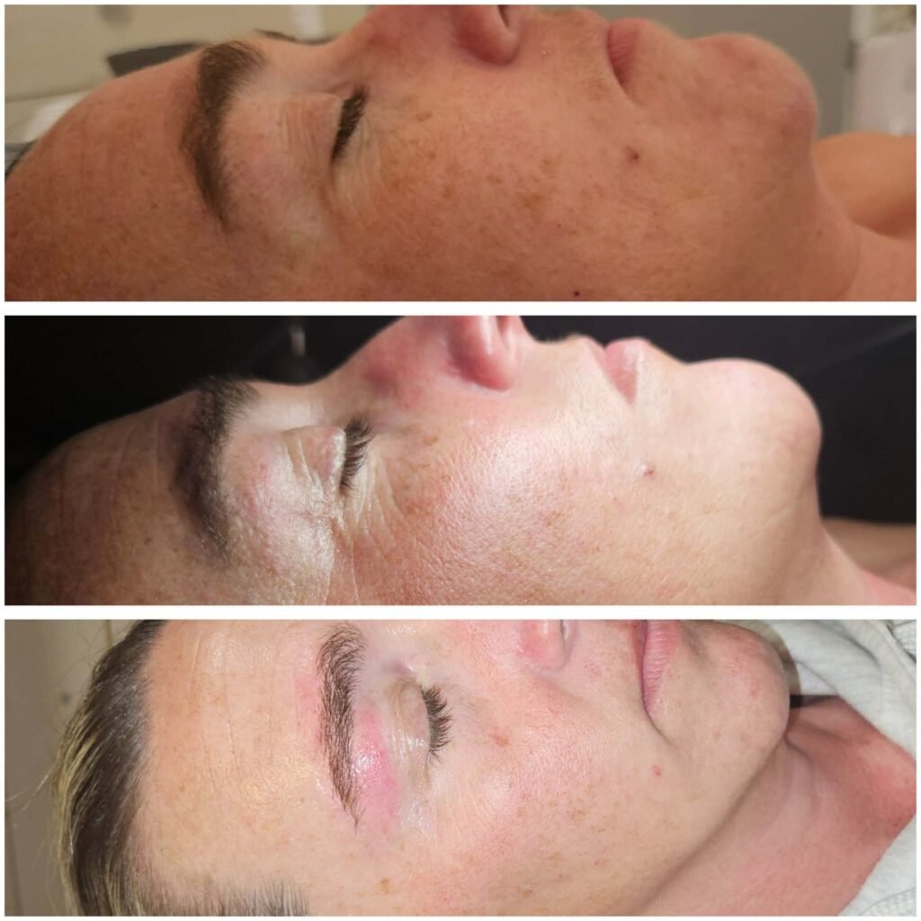 Before and after brow wax with Circadia facial and dermaplane