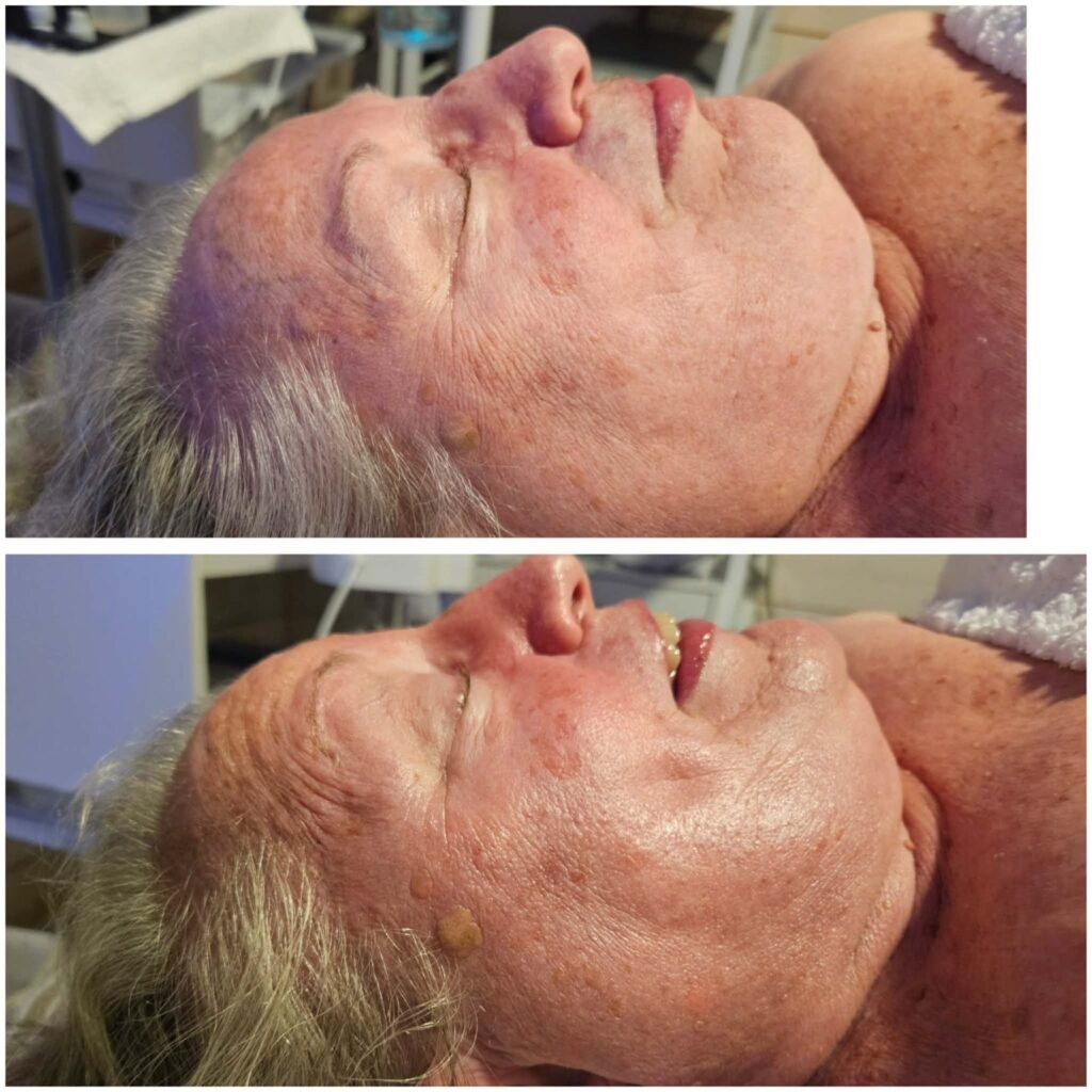 Before and after a Deluxe HydraFacial at Bare Beauty