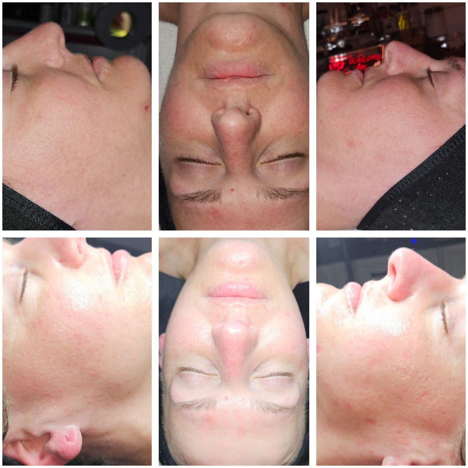 Before and after dermaplaning treatment