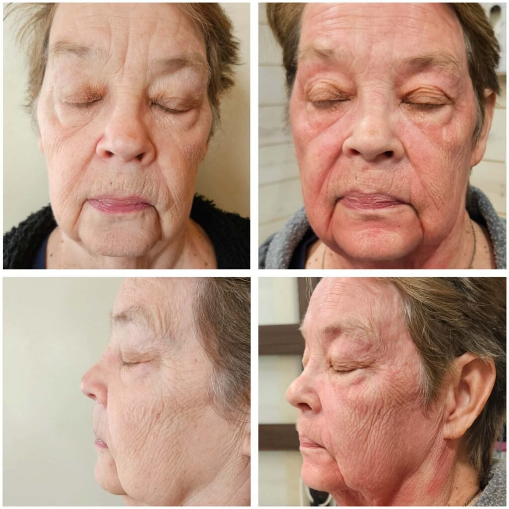 Before and after PRP microneedling results