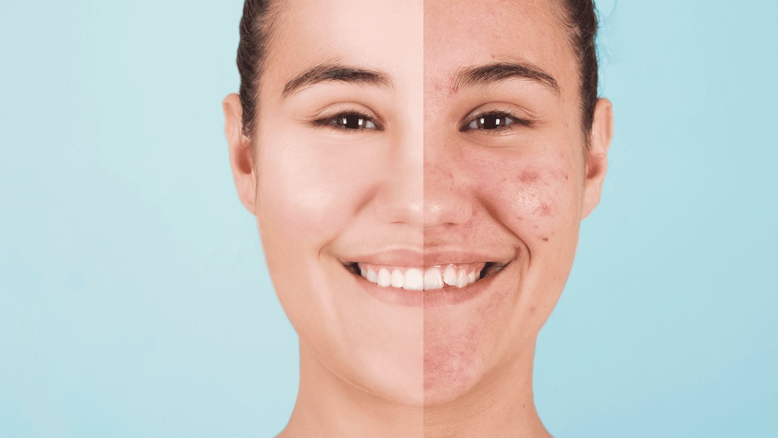 Acne scar treatment before and after