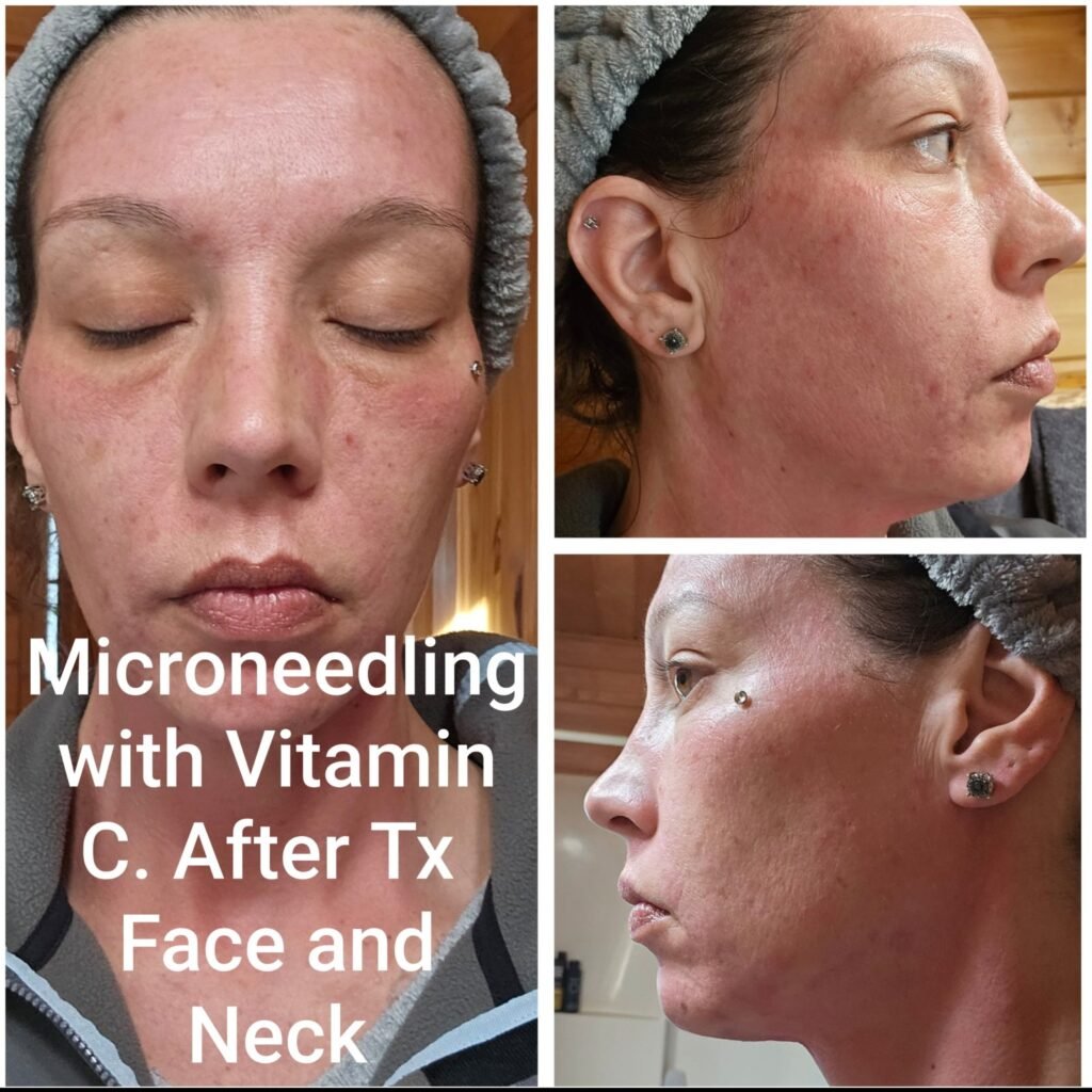 Microneedling with vitamin C serum results