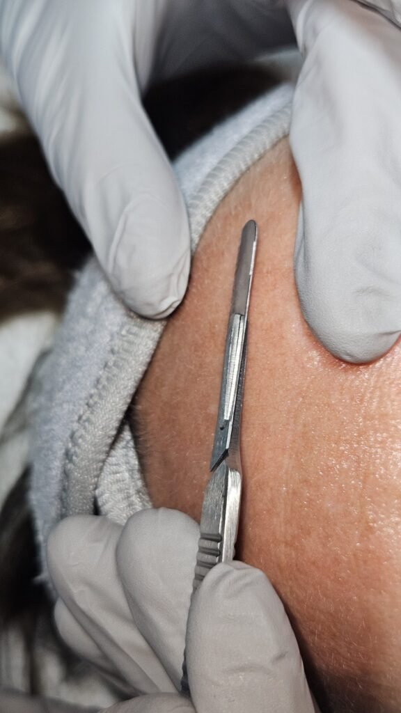 Dermaplaning treatment in Hayward, WI