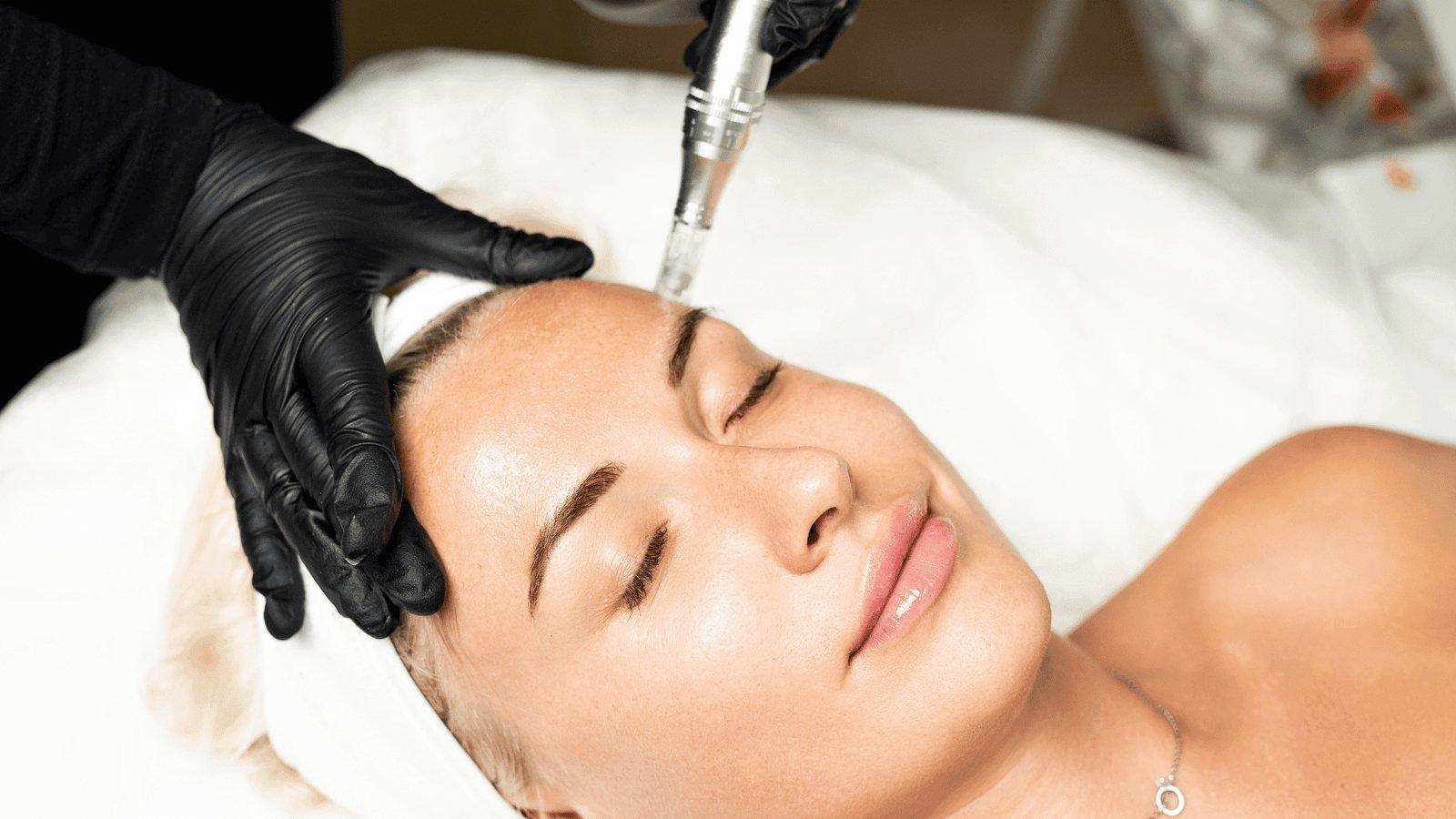 Microneedling treatment for smoother skin texture
